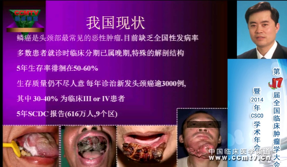 郭伟:额面-头颈部鳞癌EGFR单抗靶向治疗的进展及初探 - 头颈肿瘤论坛 - 临床频道(CCMTV)_官网 看病例讨论,高清医学手术视频,学术会议的首选视频新媒体,医学视频网,临床医学视频下载