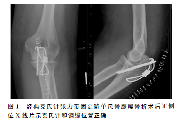 尺骨鹰嘴骨折手术技巧