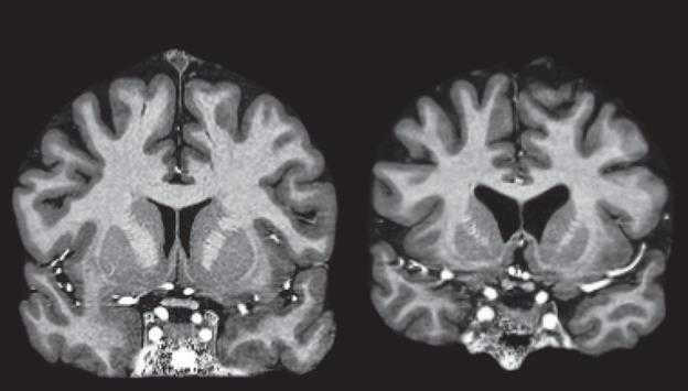 亨廷顿病 知多少?(Nature 综述) - 神经内科讨论