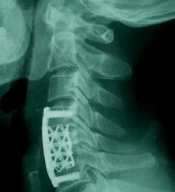 首例4节颈椎切除:北医三院骨科团队应用3D打