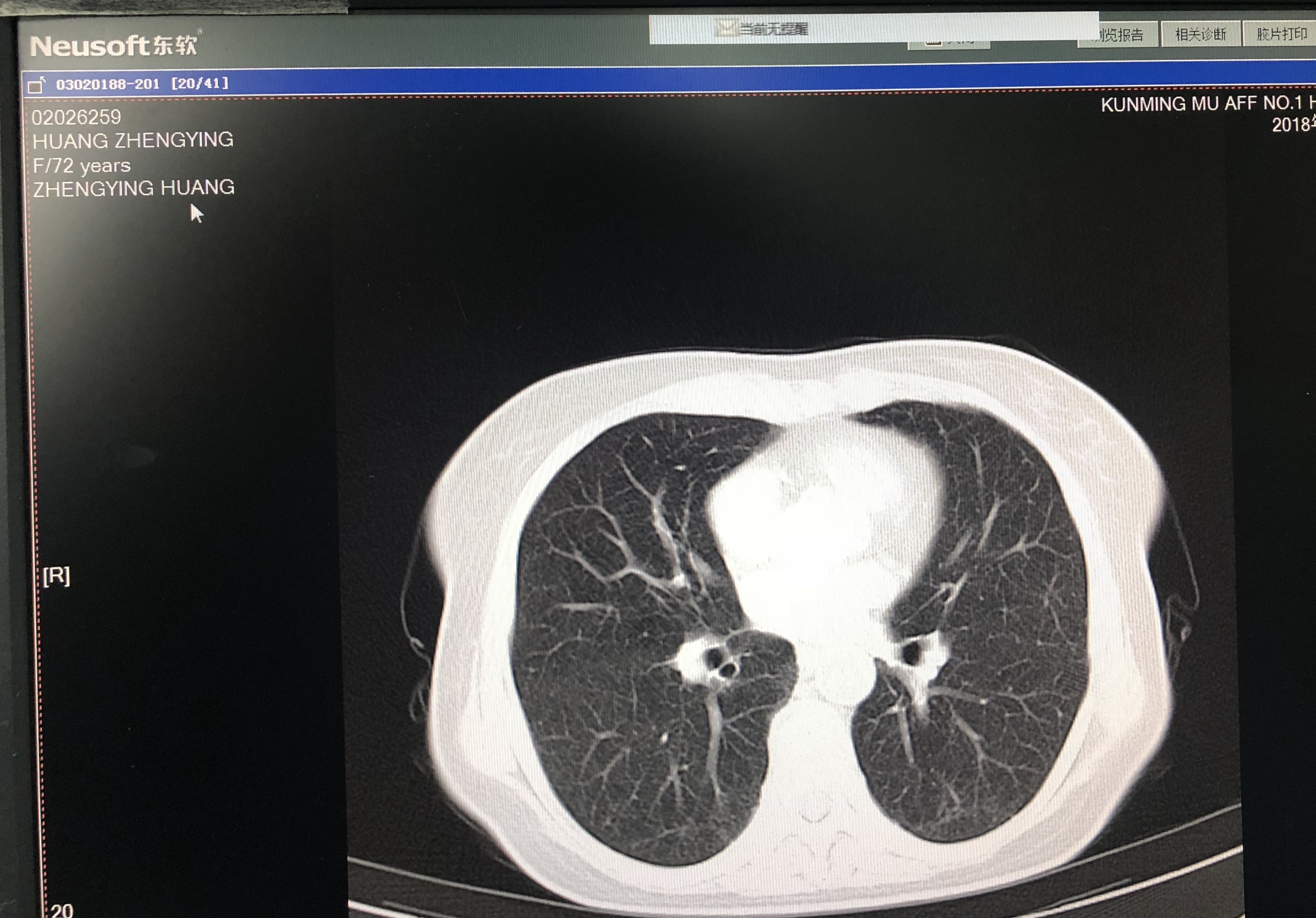 小淋巴细胞淋巴瘤能治吗 1545992011761747.jpg
