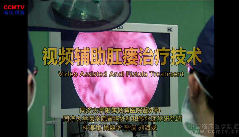 消化道疾病 手术 微创 内镜 肛瘘 李镇：VAAFT - 视频辅助肛瘘治疗手术