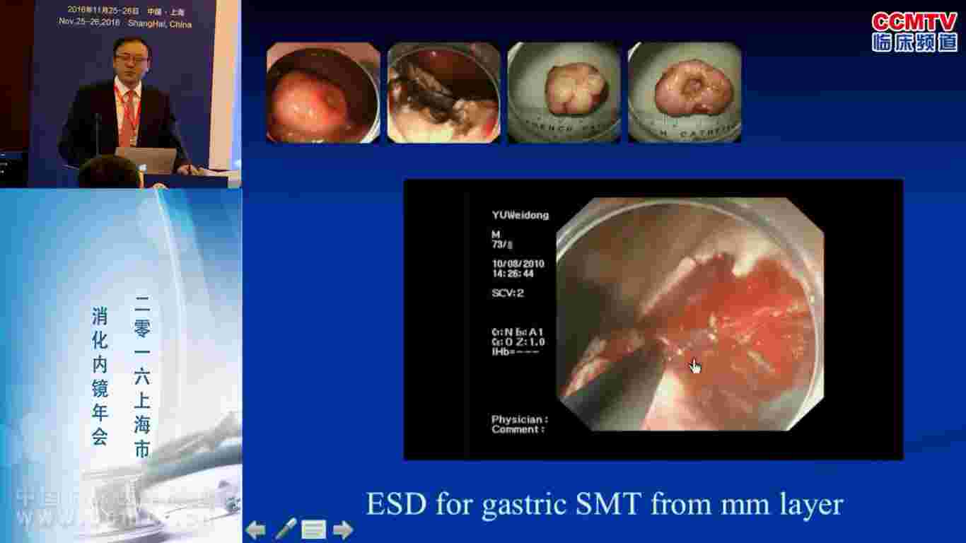 消化道疾病 外科讲坛 EFTR 内镜 周红平：EFTR（内镜下全程切除）技术新进展