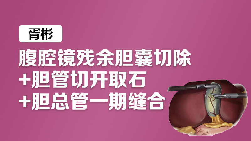 胆囊切除 胆管切开取石 胆总管 胥彬：腹腔镜残余胆囊切除+胆管切开取石+胆总管一期缝合