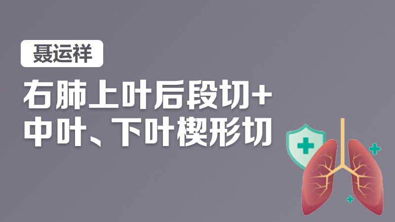 肺癌 肺部结节 腺癌 聂运祥：右肺上叶后段切+中叶、下叶楔形切