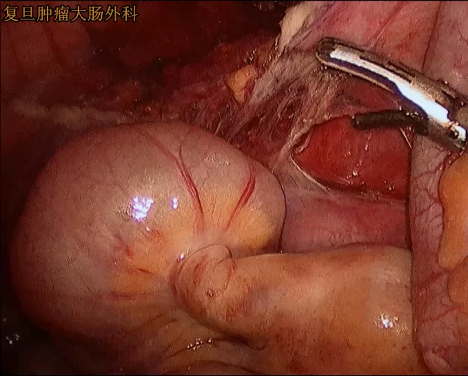 腹腔镜直肠手术
