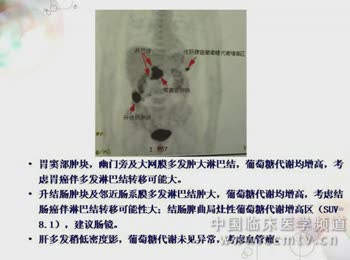 复旦肿瘤：多源发胃肠肿瘤术后复发