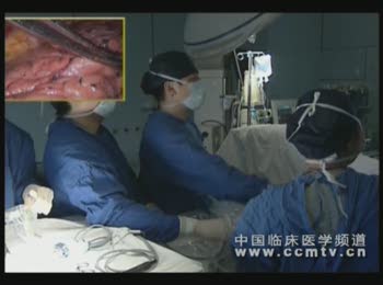 赵晓菁：胸腔镜肺叶切除术（含讲解）