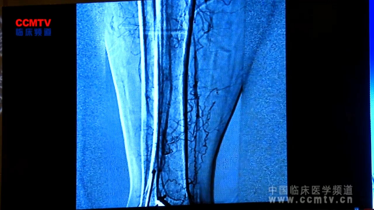 陆信武：右侧股腘动脉闭塞支架成形术（含讲解）