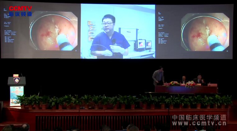 2015上海国际消化内镜研讨会手术直播 - 消化道内镜下胃肠疾病手术（刘志国等，含讲解）