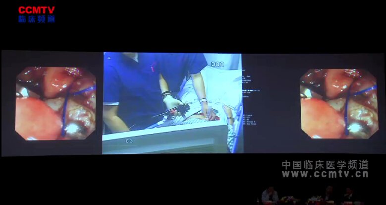 2015上海国际消化内镜研讨会手术直播 - 内镜下胃肠肿瘤切除与闭合（徐美东等，含讲解）