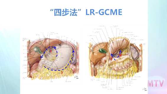 刘忠臣：四步法腹腔镜远端胃癌全系膜根治术（LR-GCME，含讲解）