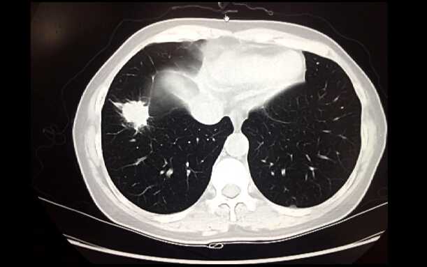 李鹤成：单孔胸腔镜右肺下叶切除术（含讲解）