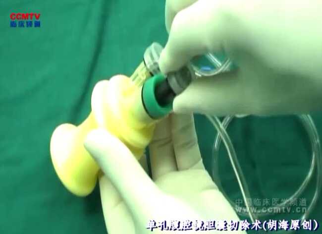 胡海：单孔腹腔镜胆囊切除术