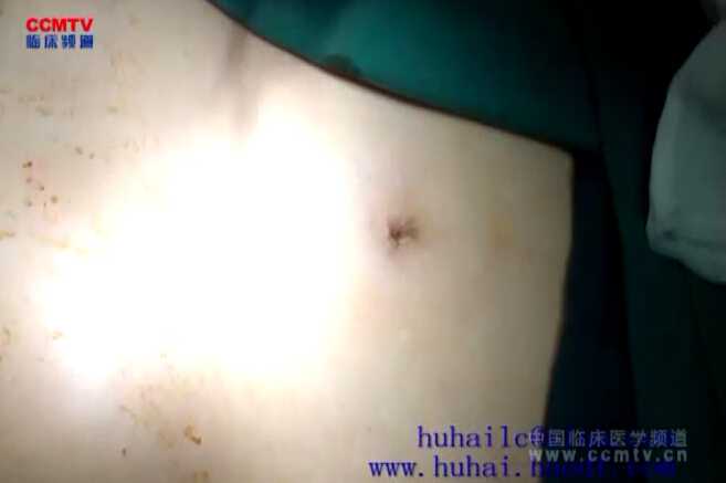 胡海：迷你腹腔镜保胆取石术