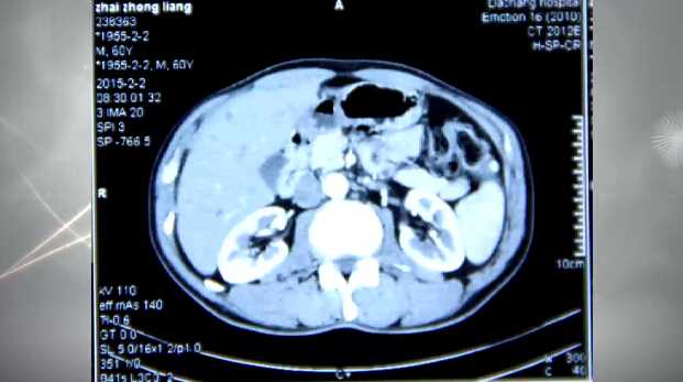 葛步军：全腹腔镜下胃窦癌根治术（含讲解）