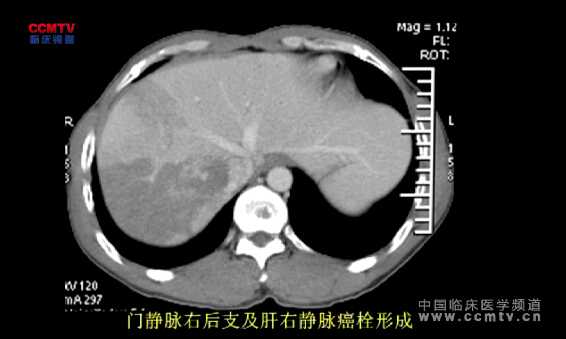 袁周：右半肝切除+肝右静脉癌栓取出术