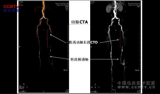 陆信武：内膜下血管成形术治疗股浅动脉长段慢性完全闭塞性病变（含讲解）
