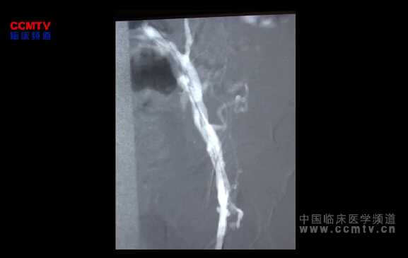 陆信武：各个入路不同入路治疗髂股静脉PTS（含讲解）