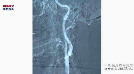 陆信武：老年颈动脉狭窄CAS术（含讲解）