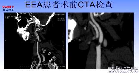 陆信武：颈动脉内膜剥脱术（EEA，含讲解）