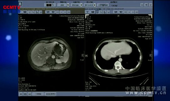 复旦肿瘤：乙状结肠癌伴肝转移评估转移灶手术可能
