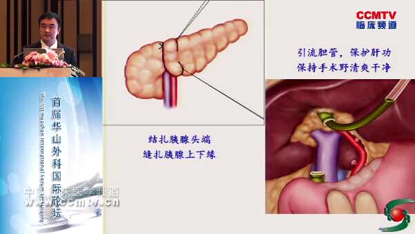 王槐志：扩大淋巴清扫、联合血管切除重建的胰十二指肠切除术（含讲解）