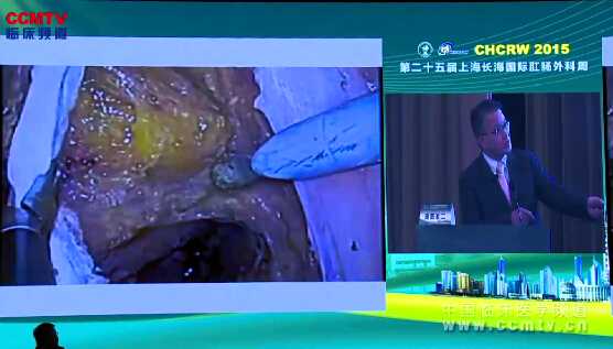 奥田准二：日本腹腔镜直肠癌手术最前沿进展