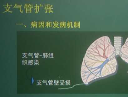 呼吸系统：支气管扩张