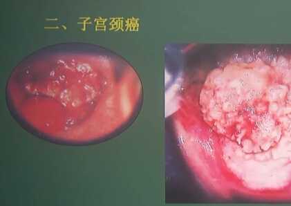 妇产科学：子宫颈癌