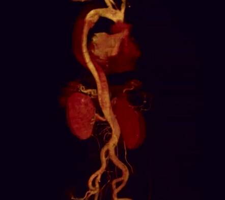 Jeng We：血管环连接器剥离A型主动脉