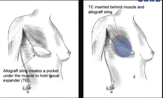 WT McClellan：保留皮肤的乳房切除术+乳房重建术（Part1）