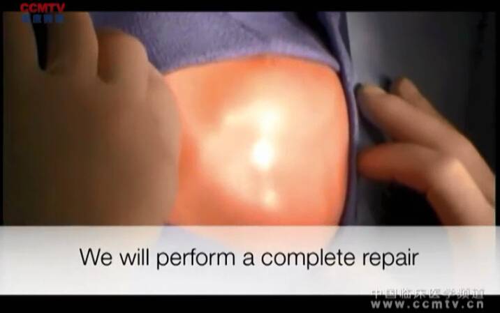 RP Burke：新生儿主动脉弓室间隔缺损修复