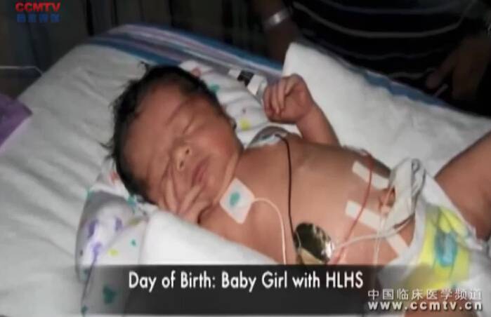 RP Burke：早产儿HLHS一期姑息治疗