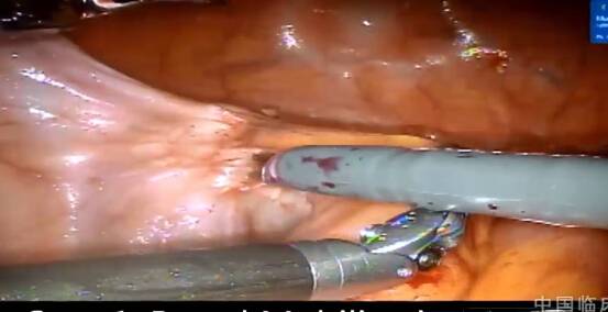 机器人输尿管再植术及膀胱造瘘术（输尿管支架植入术失败后）