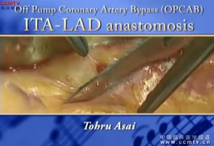 Tohru Asai：脱泵冠状动脉搭桥手术(OPCAB)胸主动脉-左前降支吻合术