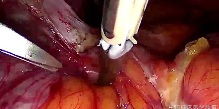 腹腔镜左输尿管侵润性子宫内膜异位症手术