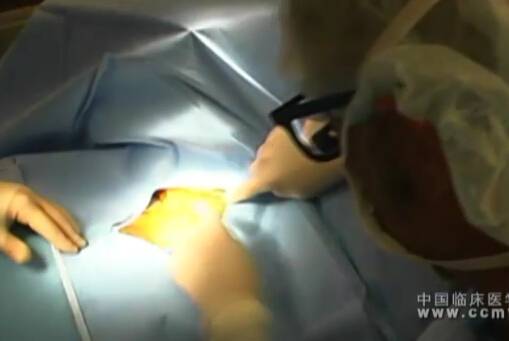 JF Eidt：颈动脉内膜切除手术