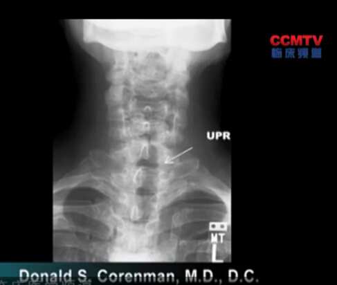 DS Corenman：颈后路椎间孔扩大术