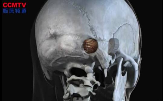 听神经瘤（乙状窦后入路 - 3D模拟）