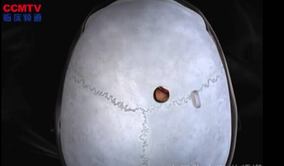 内镜侧脑室蛛网膜囊肿切除术（3D模拟入路）