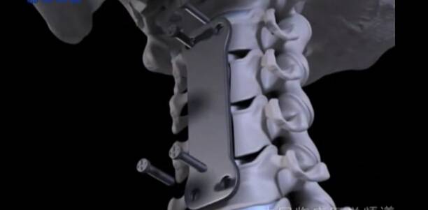颈椎椎体切除术（前入路 - 3D模拟）