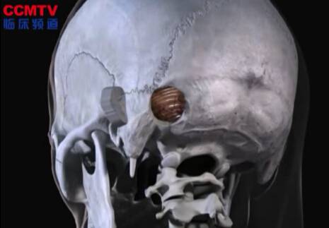 斜坡脊索瘤（左侧乙状窦后入路 - 3D模拟）