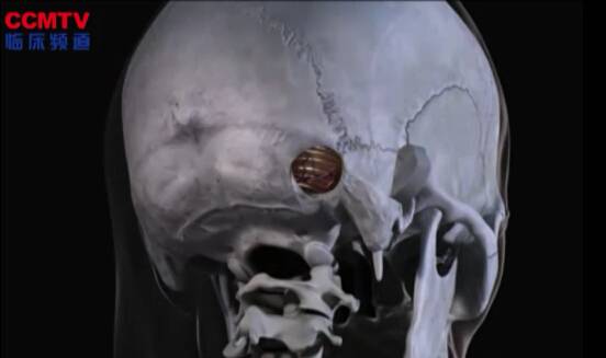 舌咽神经鞘瘤（右侧乙状窦后入路 - 3D模拟）