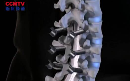 腰椎关节固定术（3D模拟入路）