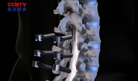 腰椎动态关节固定术（后外侧入路 - 3D模拟）