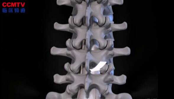 腰椎间隙关节固定术（后侧入路 - 3D模拟）