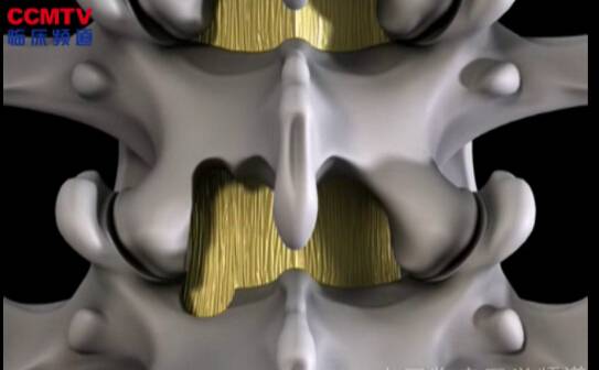 腰椎显微解剖（后部入路 - 3D模拟）