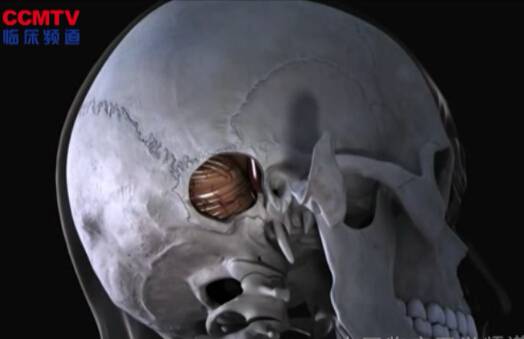 右侧面神经痉挛（耳后入路 - 3D模拟）
