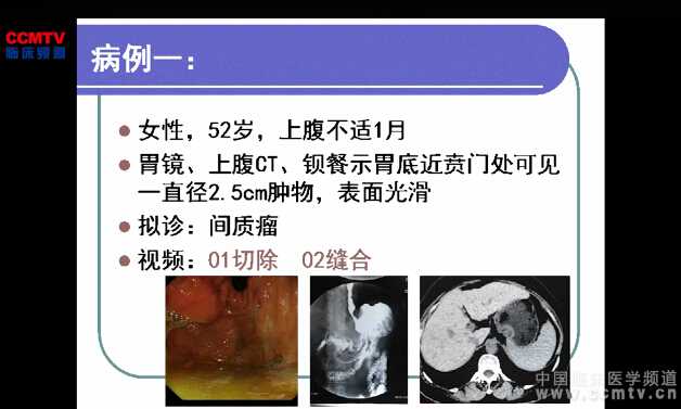 司徒升：腹腔镜经胃壁胃腔内手术